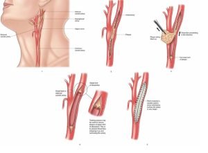 Carotid endarterectomy