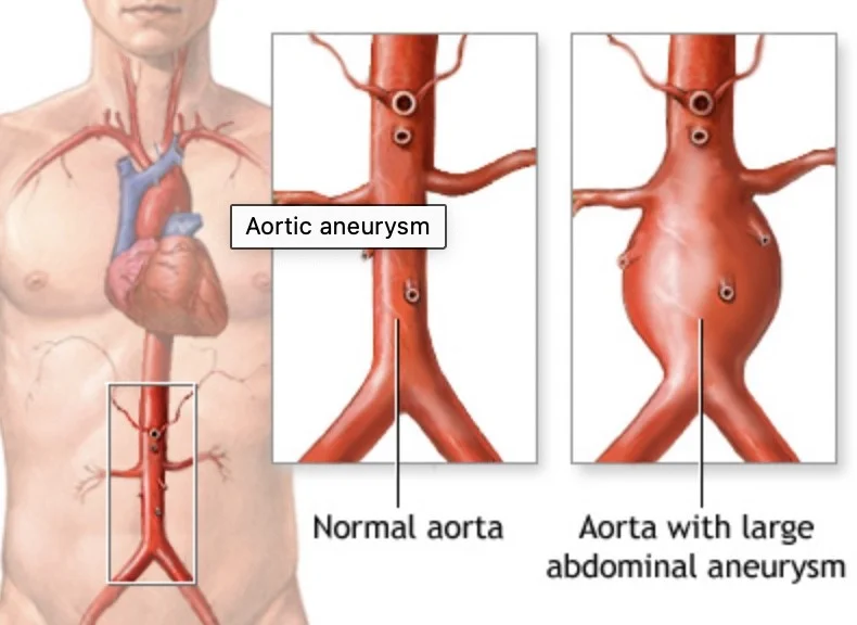 Abdominal aortic aneurysm