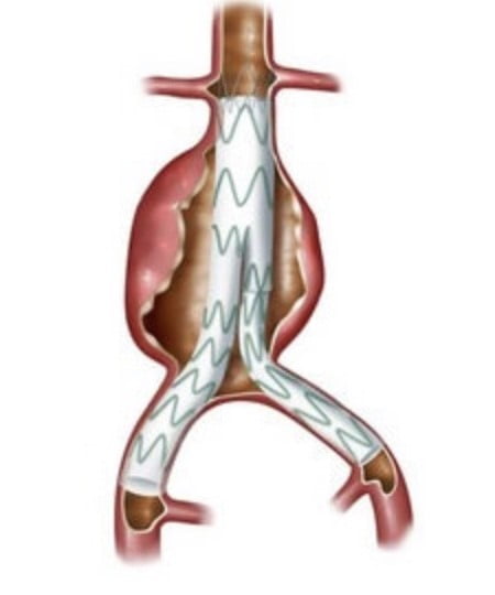 Endograft repair of abdominal aortic aneurysm
