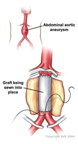 Open abdominal aortic aneurysm repair