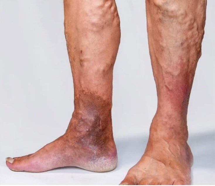 varicose veins legs