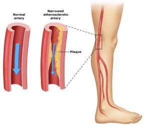 Peripheral arterial disease
