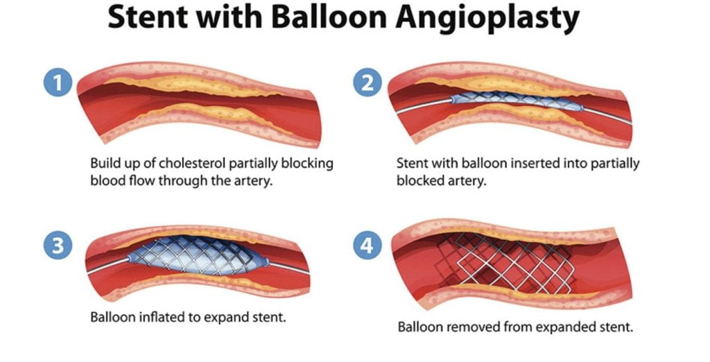 Angioplasty & stenting