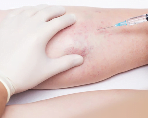 SCLEROTHERAPY VEINS