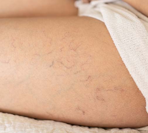 Patient preparing for spider vein treatment