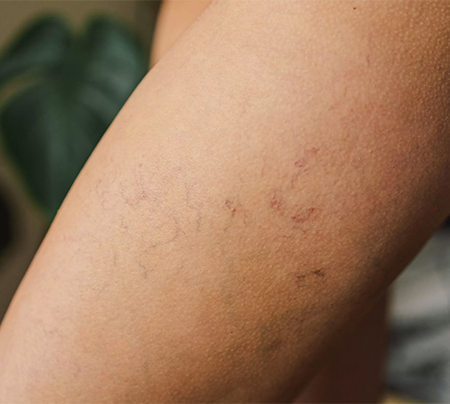 Patient with varicose veins