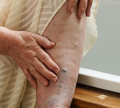 Atherosclerosis pain